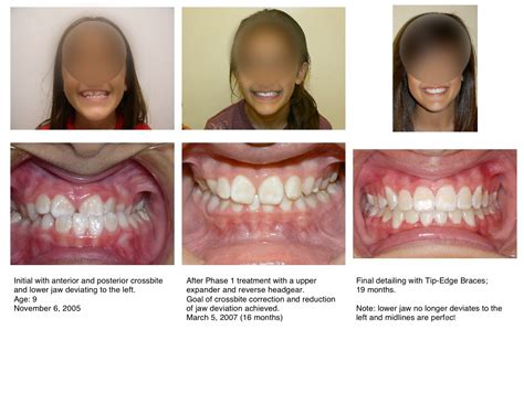 Severe underbites might require invisalign treatment combined with surgery. Braces