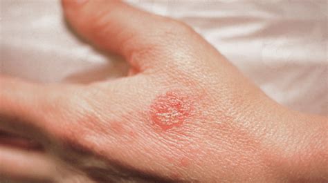 Nummular Eczema Pictures Treatment And More