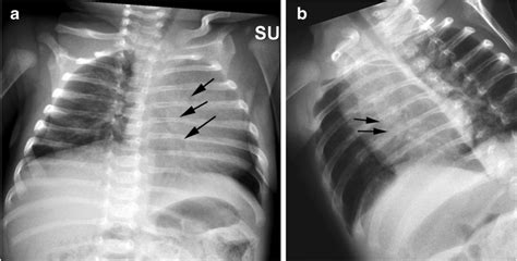 A False Diagnosis Of Bilateral Posterior Rib Fractures In A 2 Month Old