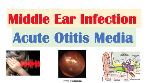 Are Ear Infections Common In Diabetics Best 7 Answer