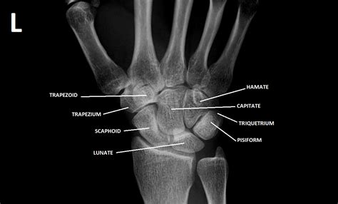 Carpal Bones Radiology