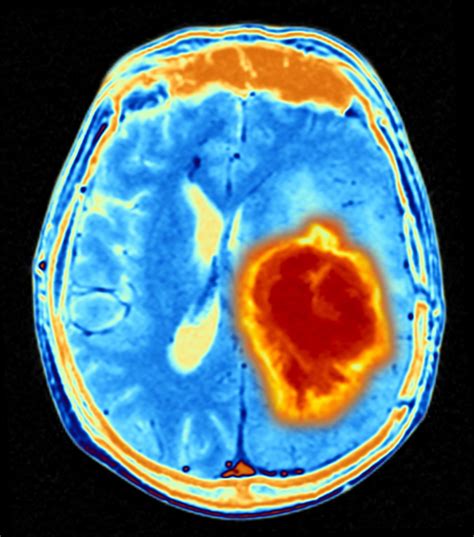 Algorithm Helps Detect Brain Cancer