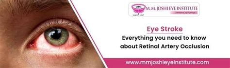 Eye Stroke All About Retinal Artery Occlusion Mmj Eye Hospital