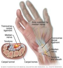 Learn about carpal tunnel syndrome symptoms and treatment. YOUR PHYSIO - Carpal Tunnel Syndrome (CTS)