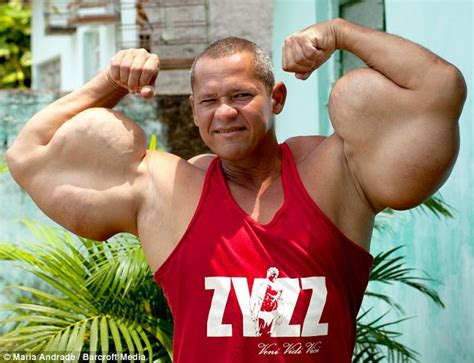 Bodybuilder Injects Himself With A Potentially Lethal Synthol To Grow