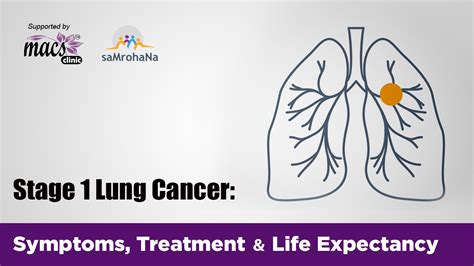 Stage 1 Lung Cancer Symptoms Treatment And Life Expectancy Macs Blogs