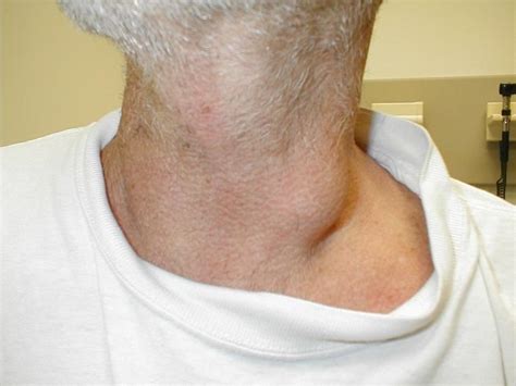 ganglions lymphatiques Enflammé dans le cou ce qu il faut faire en premier lieu