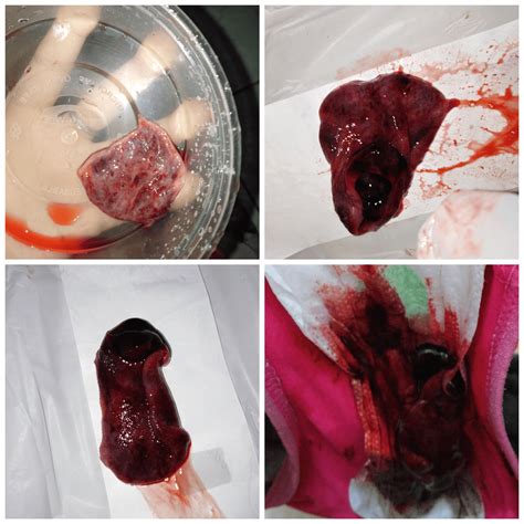 Implantation Bleeding Vs Miscarriage Tribuntech