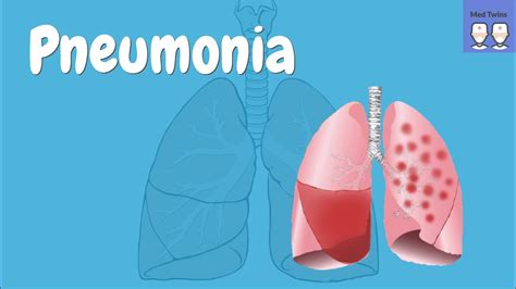 Pneumonia Overview Pathophysiology Community Vs Hospital Acquired Symptoms Curb 65 Youtube