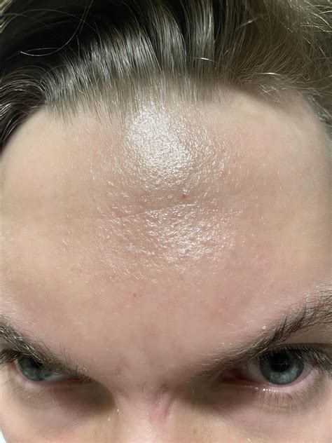 Skin Concerns Hey Still Have These Small Forehead Bumps After 6
