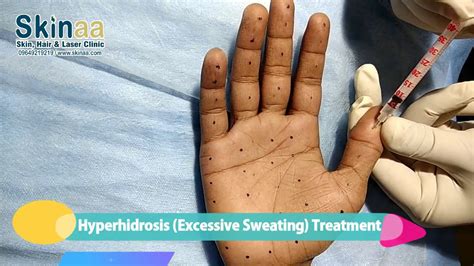 Hyperhidrosis Excessive Sweating Treatment In India Botox Injection By Dr Atul Jain Youtube