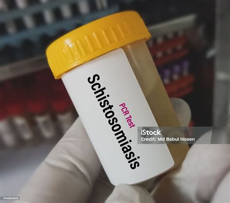 Urine Sample For Schistosoma Antibody Igg Test To Diagnosis Of