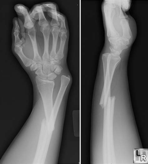 Fractured Bone