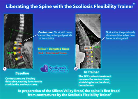 Treating Scoliosis Contractures Surgery Free Scoliosis