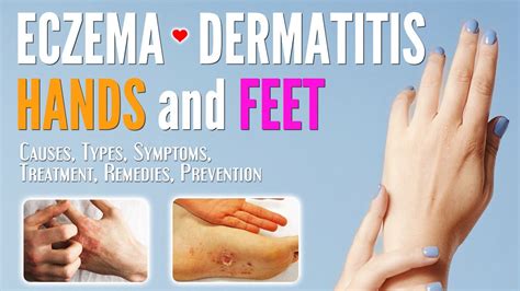 Eczema On Hands And Feet Causes Symptoms Types Treatment Remedies