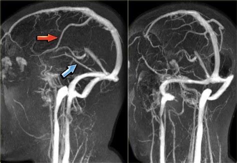 The Radiology Assistant Cerebral Venous Sinus Thrombosis