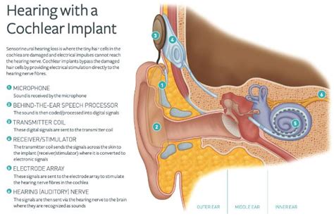Cochlear Implants Auditory Implant Service