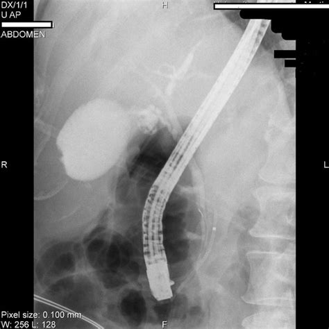 Ercp Picture Of Inserted Stents In Pancreatic Near The Arrow And Bile