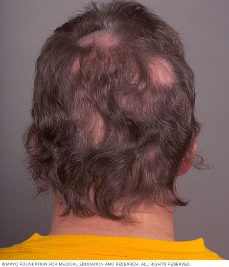 Patchy Hair Loss Alopecia Areata Mayo Clinic