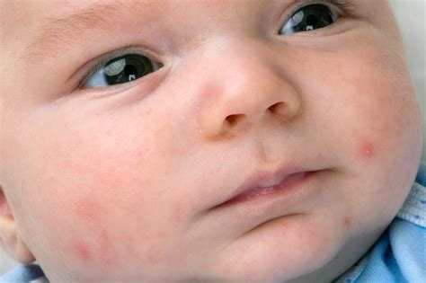 Skin Rashes In Babies Nhs
