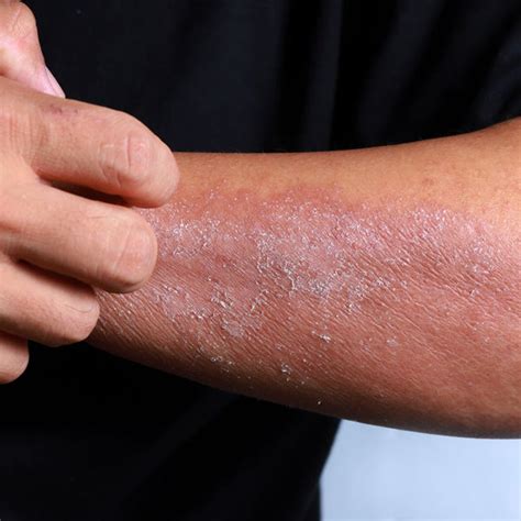 All You Need To Know About Eczema The Causes And How To Prevent It