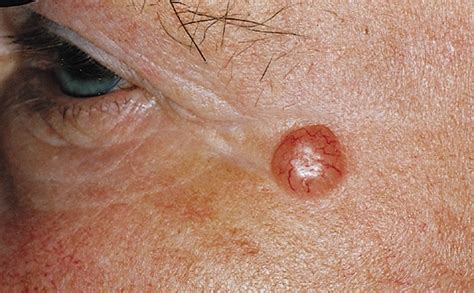 A 3 Minute Guide To Skin Cancers Dr Hm Liew Skin Clinic