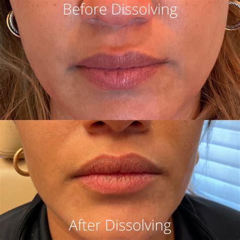 Kysse Lip Filler For Asian Womans Lips Before And After Photos New