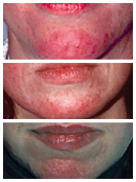 2018 Rosacea Handbook Causes Treatment Tips And Videos