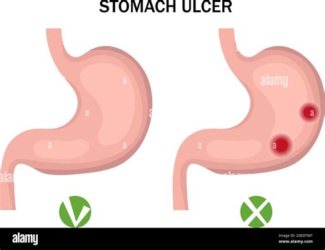 Stomach Ulcer And Healthy Stomach Infographics Medicine Concept