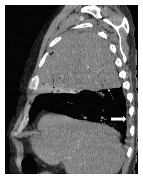 A Axial Contrast Enhanced Ct Image With Mediastinal Window Settings