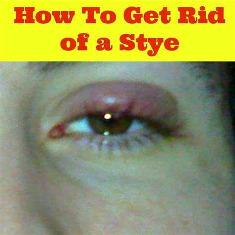 How To Get Rid Of A Stye In Your Eye Eye Stye Treatment Hubpages