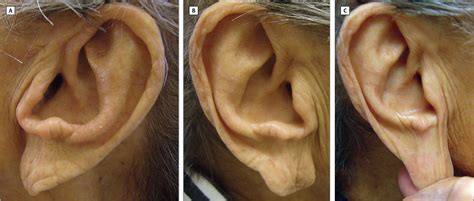 Exaggerated Earlobe Ptosis Due To Habitual Ear Pulling Dermatology