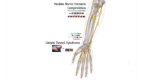 Carpal Tunnel Syndrome Feat Dr Mackinnon Youtube
