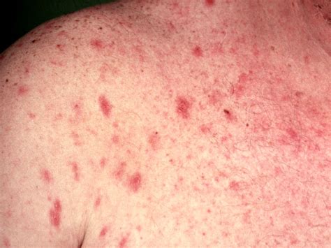 Hiv Rash Pictures What Does Hiv Rash Look Like How Is
