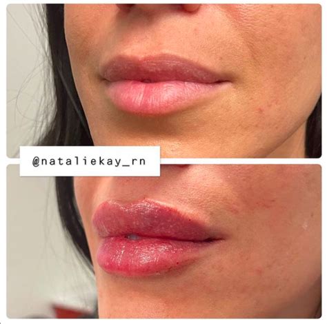 Lip Fillers Los Angeles Russian Lip Technique Best Injections Options