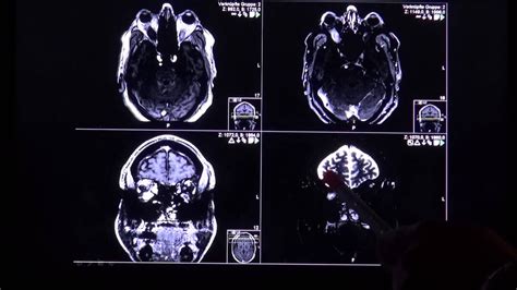 Thyroid Opthalmopathy In T2 And Stir Mri Sequence By Radiologie Tv