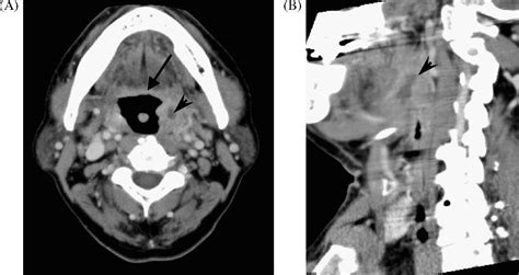 Four Cases Of Acute Epiglottitis With A Peritonsillar Abscess Auris