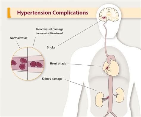 High Blood Pressure Symptoms And Causes