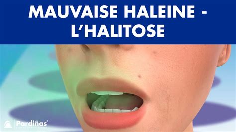 Mauvaise Haleine Lhalitose © Youtube