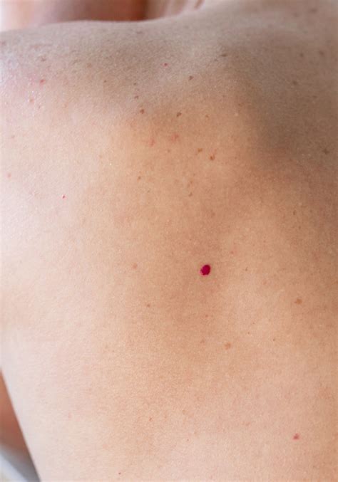 Cherry Angiomas The Laser And Skin Clinic