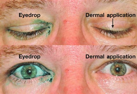 Example Of Dermal Application Of A Tracer Dye To Mimic Bimatoprost Download Scientific Diagram