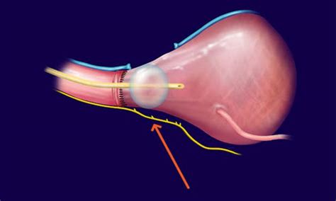 Robotic Prostatectomy Anatomy Hot Sex Picture