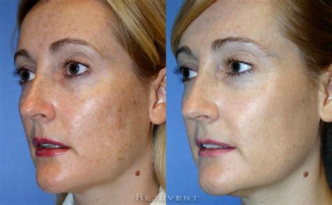 Skin Discoloration On Face Deals Outlet Save 66 Jlcatjgobmx