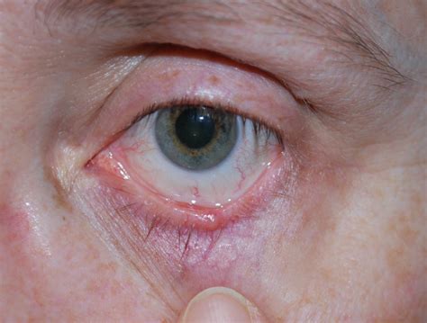 Figure Basal Cell Carcinoma Of The Left Lower Eyelid Contributed By
