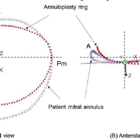 Alignment Of The Annuloplasty Ring And The Patient Mitral Annulus