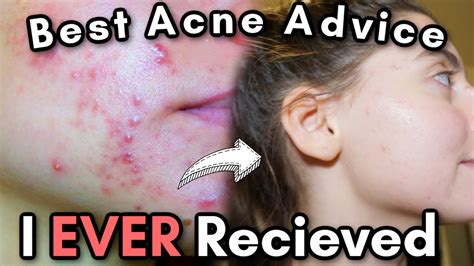 The Best Acne Advice I Have Ever Received In My Life Lol These 10