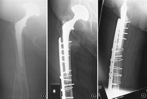 Locking Plate Fixation Of Periprosthetic Femur Fractures With And