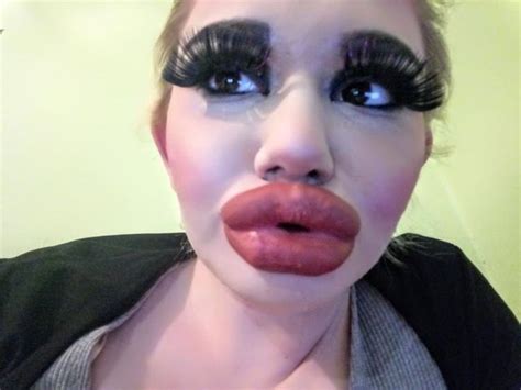 Woman Quadruples Her Lips To Have ‘biggest In The World — Unilad