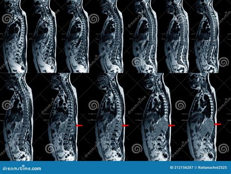 Mri Ls Spine Showing Burst Fracture Of L2 Vertebral Body With Severe
