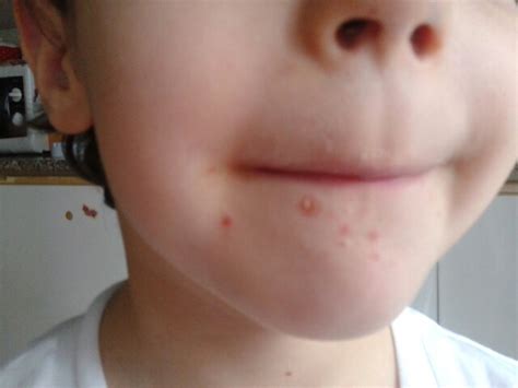 Malattia mano bocca piedi (con fotografie) - Il medico dei ...